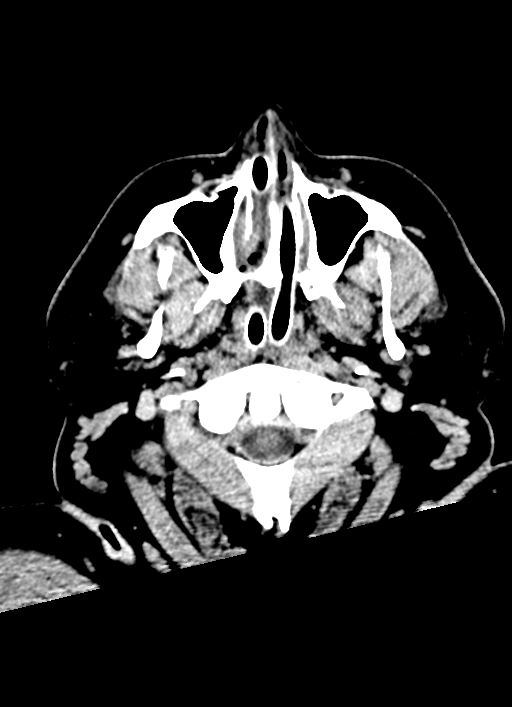 Brainstem hemorrhage (Radiopaedia 81294-94976 Axial non-contrast 64).jpg