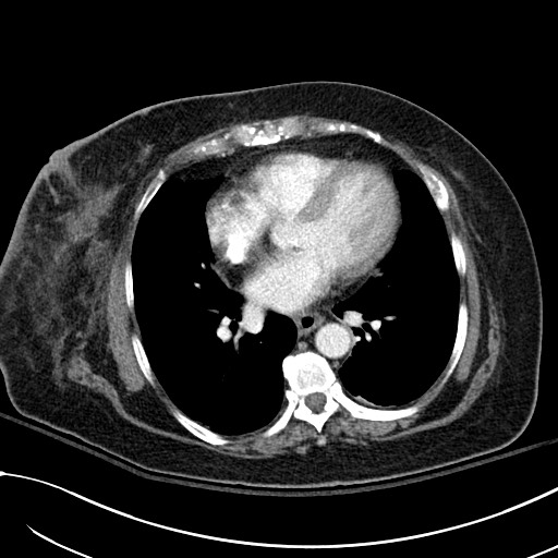 File:Breast carcinoma with pathological hip fracture (Radiopaedia 60314-67974 A 33).jpg