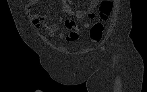 Breast carcinoma with pathological hip fracture (Radiopaedia 60314-67993 Coronal bone window 41).jpg