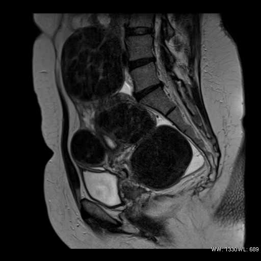File:Broad ligament fibroid (Radiopaedia 49135-54241 Sagittal T2 12).jpg