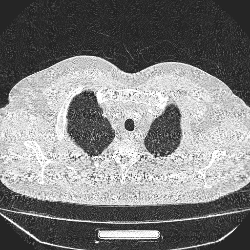 File:Bronchial atresia (Radiopaedia 58271-65417 Axial lung window 4).jpg