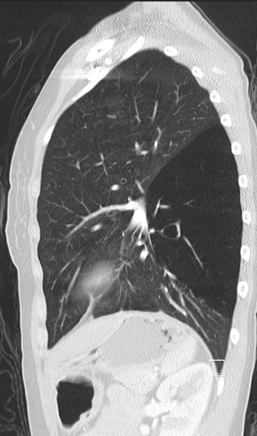 Bronchial atresia (Radiopaedia 73677-84470 Sagittal lung window 38).jpg