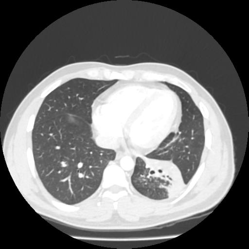 File:Bronchial carcinoid (Radiopaedia 80013-93291 Axial lung window 89).jpg