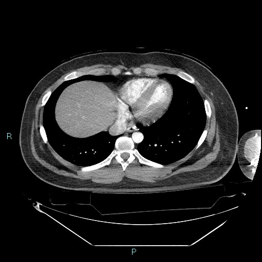 Bronchial carcinoid tumor (Radiopaedia 78272-90870 B 89).jpg