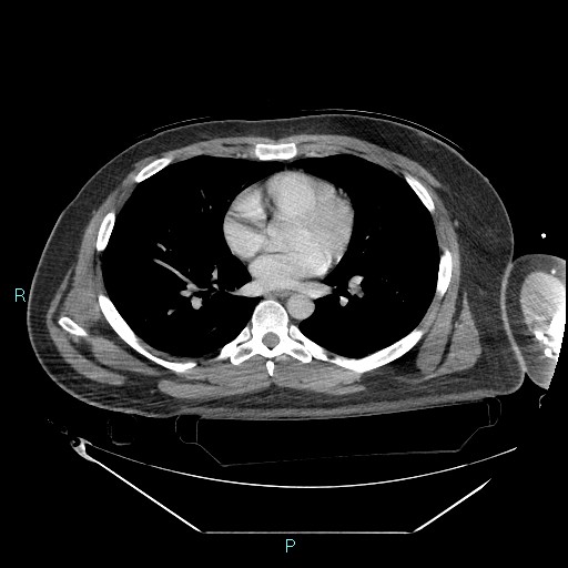File:Bronchial carcinoid tumor (Radiopaedia 78272-90870 C 70).jpg