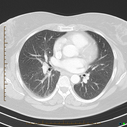 Bronchial diverticula (Radiopaedia 79512-92675 Axial lung window 25).jpg