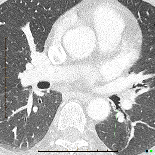 File:Bronchial diverticula (Radiopaedia 79512-92677 Axial lung window 14).jpg
