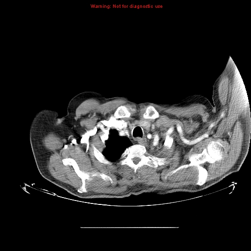 File:Bronchioloalveolar carcinoma (Radiopaedia 9272-9955 A 2).jpg
