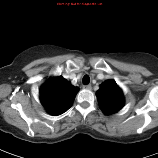 File:Bronchoalveolar carcinoma (BAC) (Radiopaedia 13436-13392 B 7).jpg
