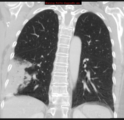 Bronchoalveolar carcinoma (BAC) (Radiopaedia 13436-13392 Coronal lung window 40).jpg