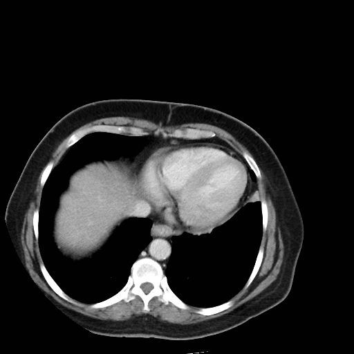 Bronchogenic carcinoma (Radiopaedia 73497-84262 A 48).jpg