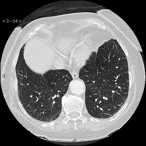 Bronchogenic carcinoma as an incidental finding (Radiopaedia 16453-16130 Axial lung window 34).jpg