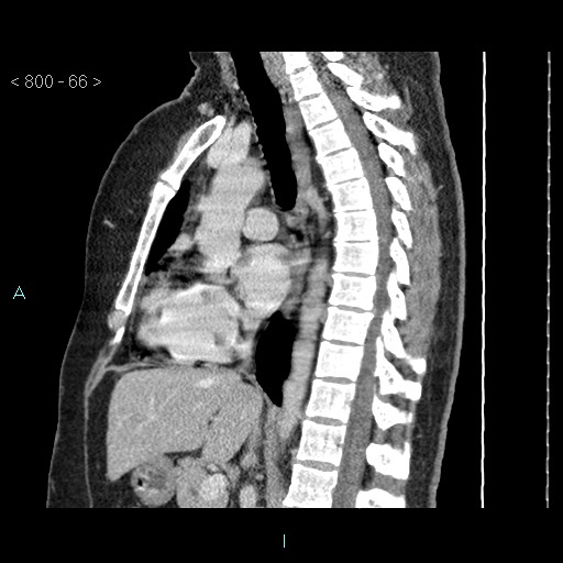 Bronchogenic cyst - posterior mediastinal (Radiopaedia 43885-47364 B 43).jpg