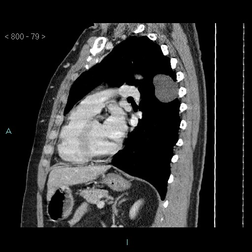 Bronchogenic cyst - posterior mediastinal (Radiopaedia 43885-47364 B 52).jpg