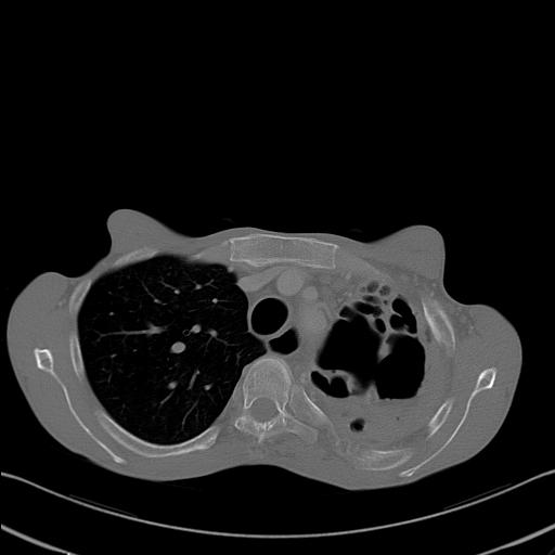 File:Bronchopleural fistula secondary to tuberculosis (Radiopaedia 20415-20322 Axial bone window 9).jpg