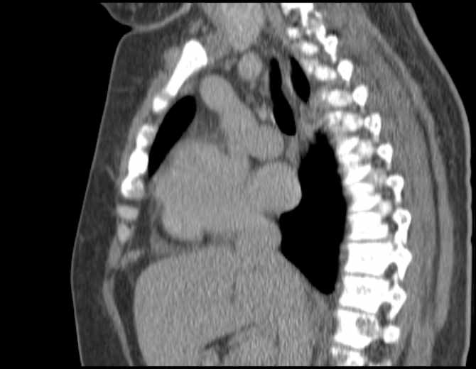 Brown tumors compressing the spinal cord (Radiopaedia 68442-77988 B 28).jpg