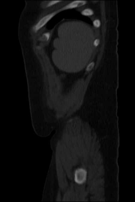 Brown tumors compressing the spinal cord (Radiopaedia 68442-77988 H 51).jpg