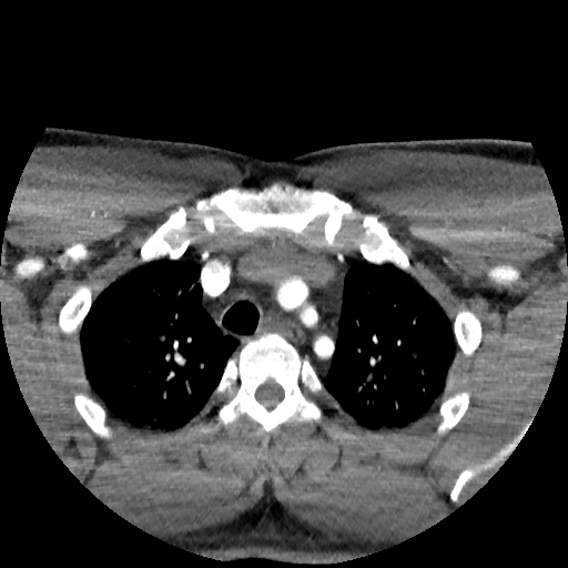 Buccal fat pad arteriovenous malformation (Radiopaedia 70936-81144 D 6).jpg