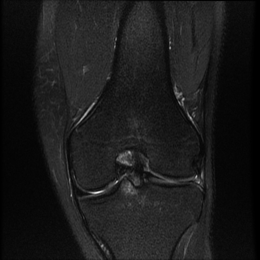 File:Bucket-handle meniscus tear (Radiopaedia 65700-74809 Coronal T2 fat sat 10).jpg