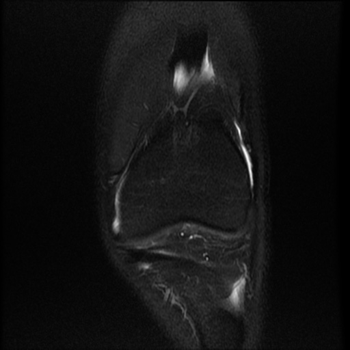 File:Bucket-handle meniscus tear (Radiopaedia 65700-74809 Coronal T2 fat sat 16).jpg