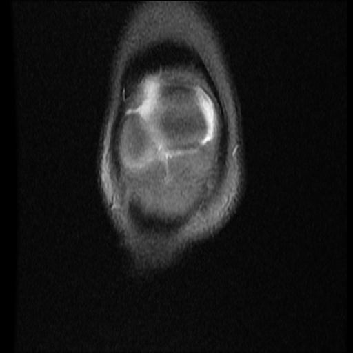 File:Bucket handle tear - lateral meniscus (Radiopaedia 72124-82634 Coronal PD fat sat 2).jpg