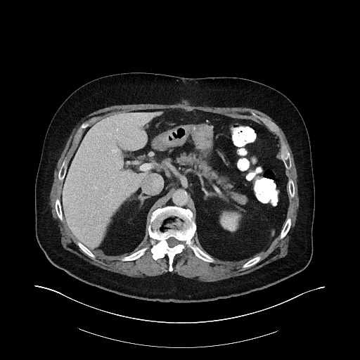 File:Buried bumper syndrome - gastrostomy tube (Radiopaedia 63843-72575 A 15).jpg