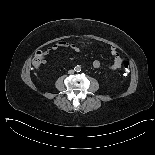File:Buried bumper syndrome - gastrostomy tube (Radiopaedia 63843-72577 Axial Inject 67).jpg