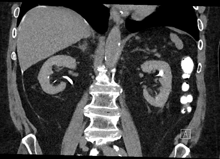 Buried bumper syndrome - gastrostomy tube (Radiopaedia 63843-72577 Coronal Inject 81).jpg