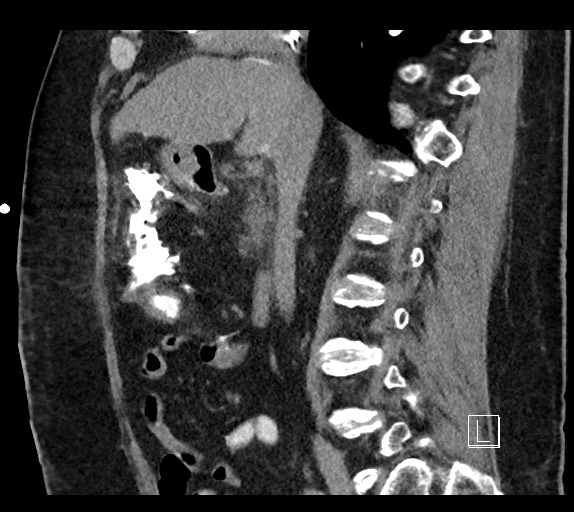 Buried bumper syndrome - gastrostomy tube (Radiopaedia 63843-72577 Sagittal Inject 71).jpg