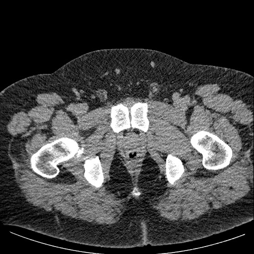 Burned-out testicular seminoma - retroperitoneal nodal metastases (Radiopaedia 62872-71245 A 73).jpg