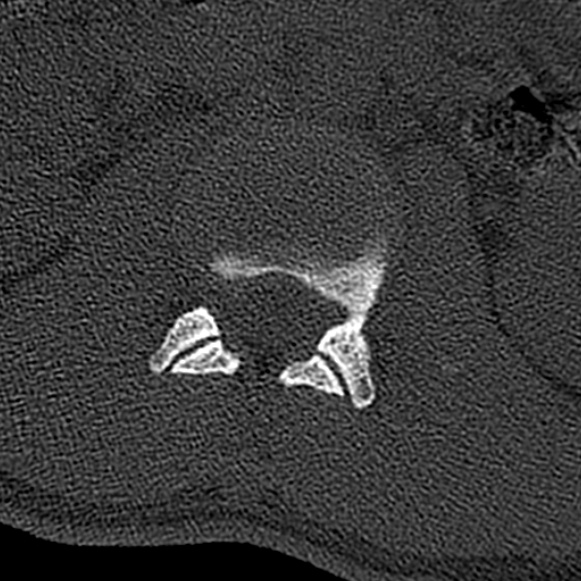 File:Burst fracture (Radiopaedia 53373-59357 Axial bone window 18).jpg