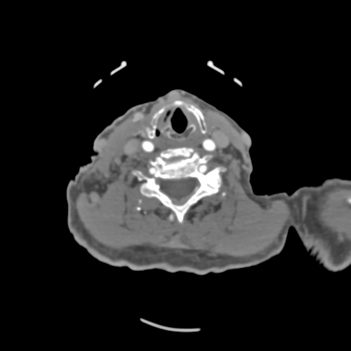 File:C2 fracture with vertebral artery dissection (Radiopaedia 37378-39200 A 108).png