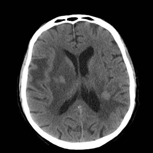 File:CNS lymphoma (Radiopaedia 36983-38639 Axial non-contrast 22).png