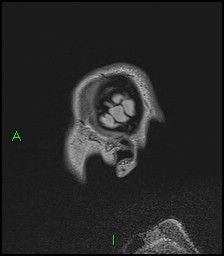 CNS manifestations of NF1 - optic pathway glioma, neurofibroma, dural ectasia (Radiopaedia 37874-39805 Sagittal FLAIR 10).jpg