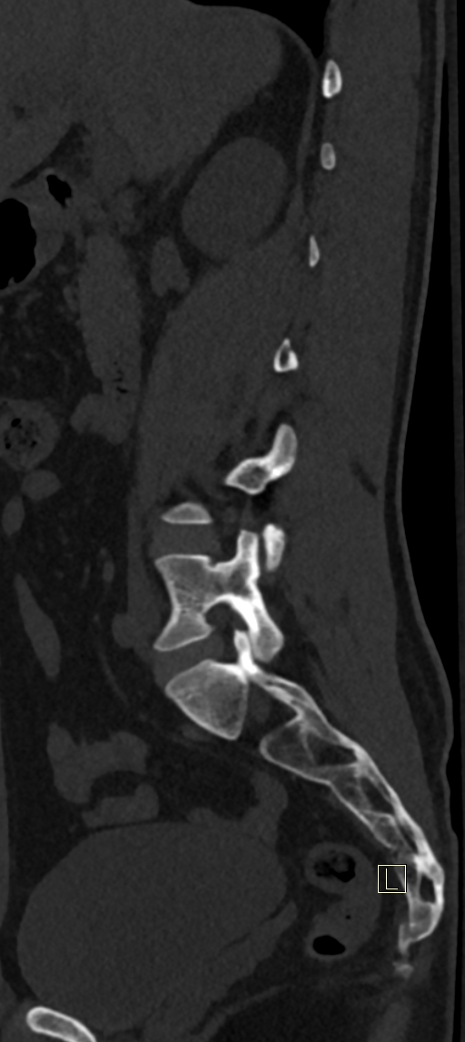 Calcaneal fractures with associated L2 burst fracture (Radiopaedia 71671-82493 Sagittal bone window 57).jpg