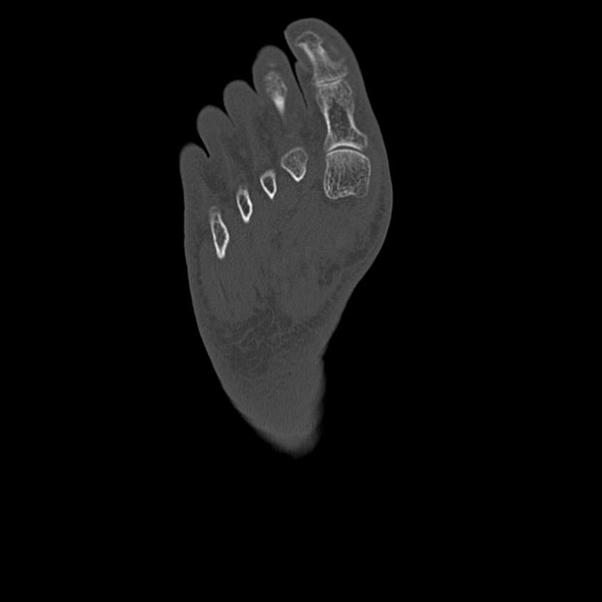 Calcaneal tuberosity avulsion fracture (Radiopaedia 22649-22668 Axial bone window 49).jpg