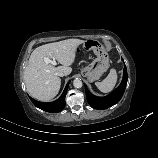 Calcified adrenal glands and Spigelian hernia (Radiopaedia 49741-54988 A 42).jpg