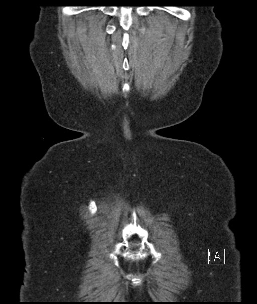 Calcified adrenal glands and Spigelian hernia (Radiopaedia 49741-54988 B 112).jpg