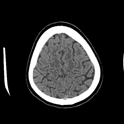 Calcified cerebral hydatid cyst (Radiopaedia 65603-74717 Axial non-contrast 66).jpg