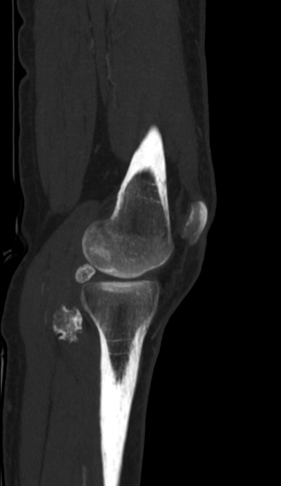 Calcified hematoma - popliteal fossa (Radiopaedia 63938-72763 D 8).jpg