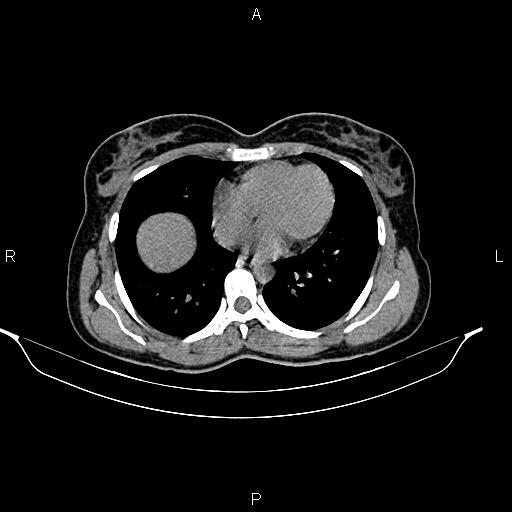 File:Calcified hepatic hydatid cyst (Radiopaedia 84672-100095 Axial non-contrast 6).jpg