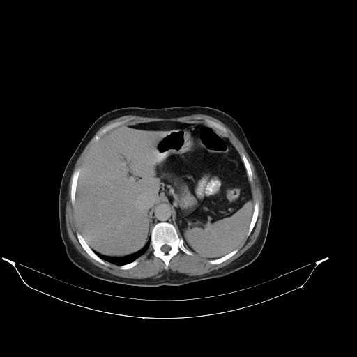 File:Calcified hydatid cyst of the liver (Radiopaedia 21212-21112 Axial C+ delayed 14).jpg