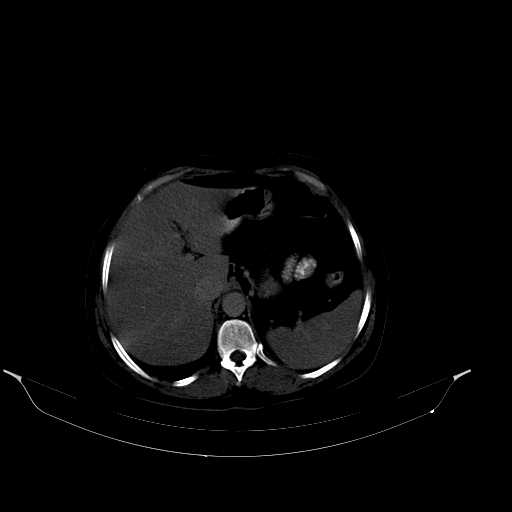 File:Calcified hydatid cyst of the liver (Radiopaedia 21212-21112 Axial bone window 14).jpg