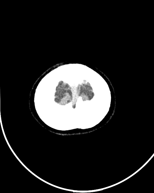 Calcified meningioma (Radiopaedia 74361-85243 Axial non-contrast 2).jpg