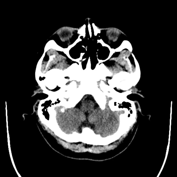 Calvarial osteoma (Radiopaedia 36520-38079 Axial non-contrast 9).jpg