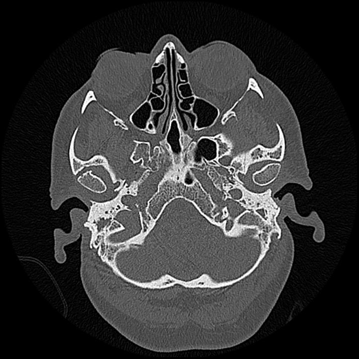 Canal up mastoidectomy (Radiopaedia 78108-90638 Axial bone window 35).jpg