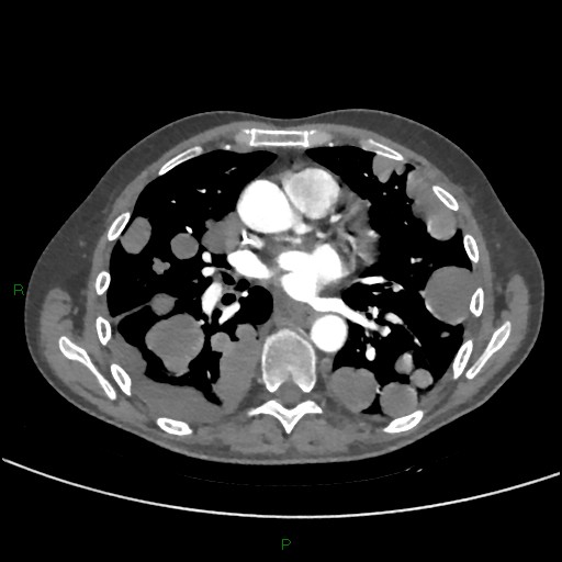 Cannonball metastases (Radiopaedia 82110-96150 Axial C+ CTPA 179).jpg