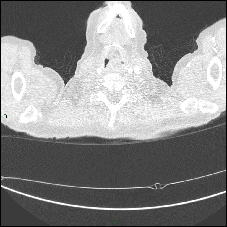 Cannonball metastases (Radiopaedia 82110-96150 Axial lung window 4).jpg