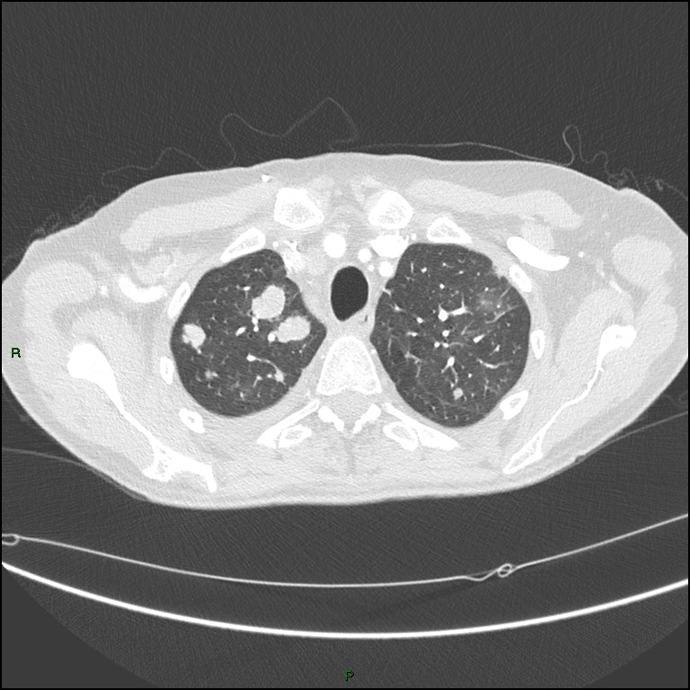 Cannonball metastases (Radiopaedia 82110-96150 Axial lung window 47).jpg