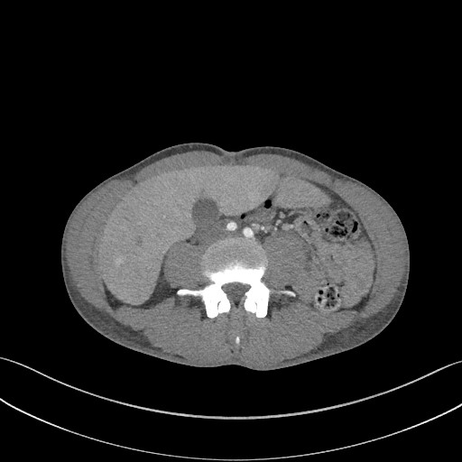 File:Cannonball metastases - testicular choriocarcinoma (Radiopaedia 84510-99891 B 144).jpg
